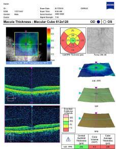 Macula Thickness Analysis Ganglion Cell Complex Clinically