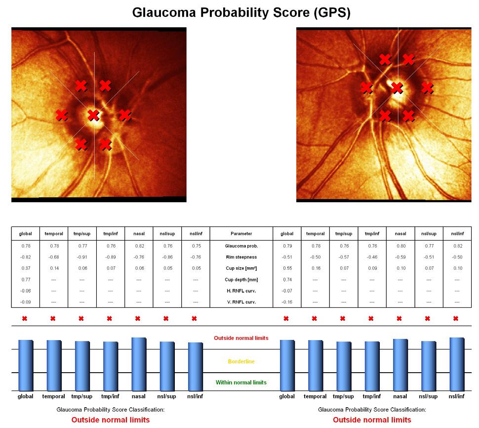 rim volume, mean RNFL thickness) all of them are signs that must have a superior clinical value to the automated analysis of the optic disc (MRA and GPS which compare the results to a statistical