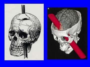 Accidents Phineas Gage Story Personality changed after