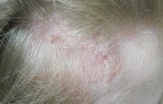 Photos courtesy of Lerner Medical Devices, Inc. Scalp psoriasis before (left) and after treatment with the at-home Levia system. the dose of each treatment, and any limitations on treatment.