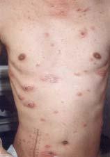 Etc. : pneumocystis carinii Malignancy : viral origin cancer hematologic : PTLD lymphoma skin cancer