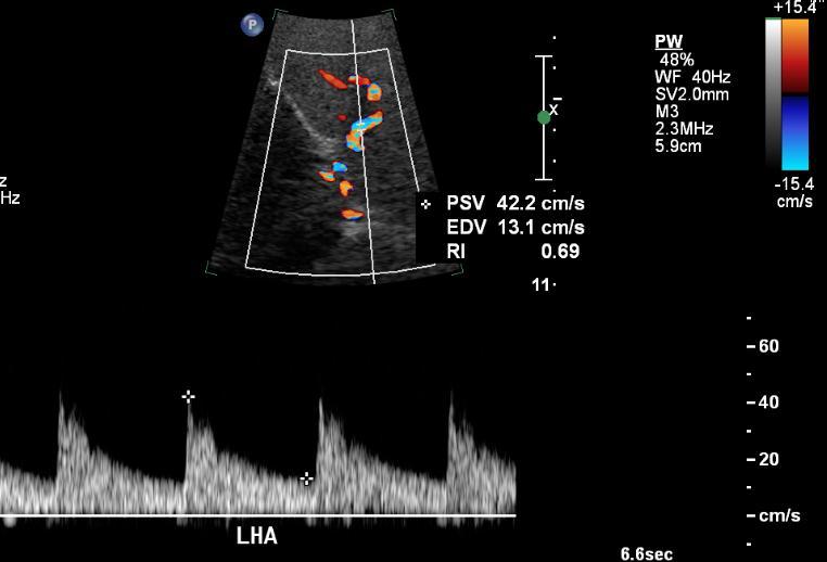 Pediatric Liver Transplant: Normal hepatic arteries Doppler Normal hepatic arteries waveforms: Rapid upstroke with continuous diastolic flow