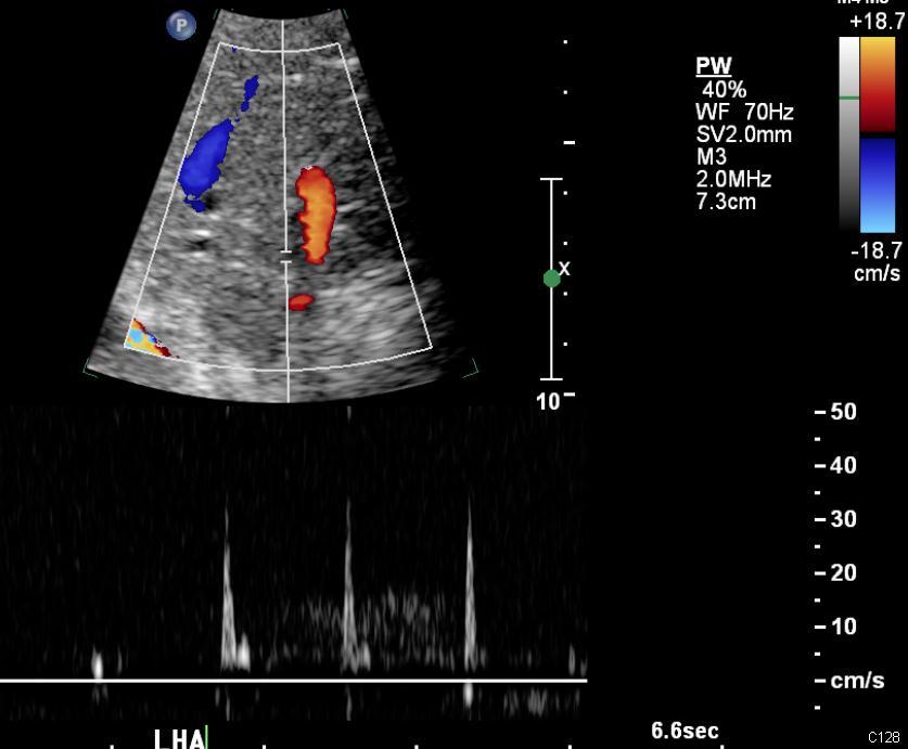 Pediatric Liver Transplant: Immediate Postoperative Doppler Absent diastolic