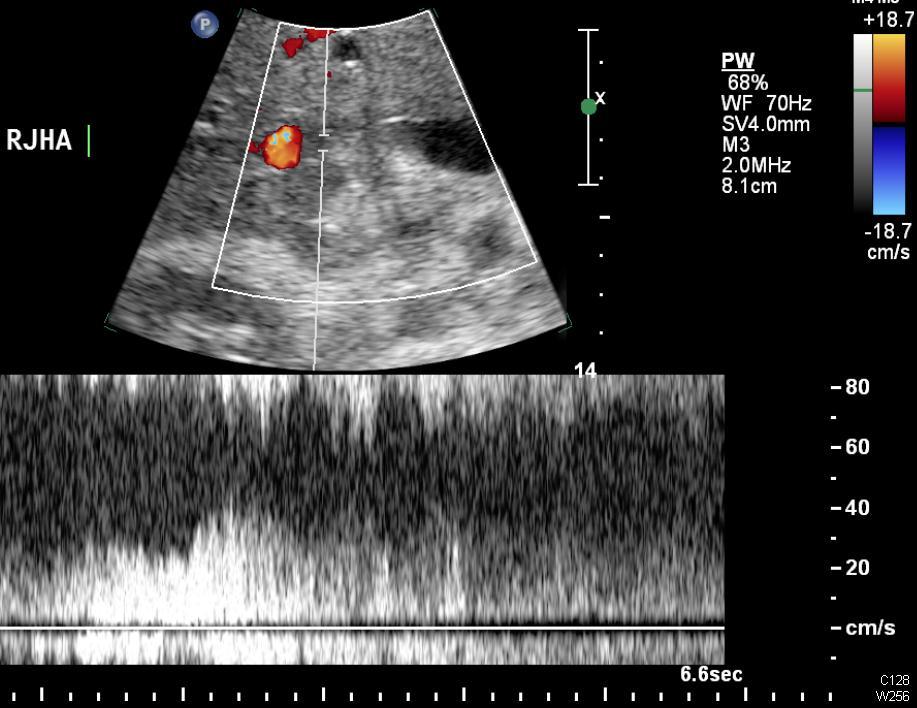 Pediatric Liver Transplant: Hepatic Artery Thrombosis Immediate