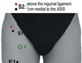 Lateral Cutaneous Nerve of the Thigh Stim 1 cm medial to ASIS Record