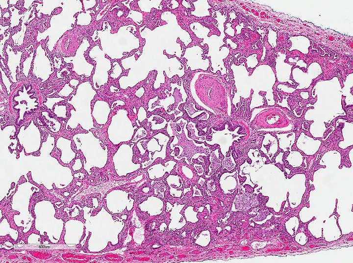 HP - Histology The Four-Part Triad Diffuse lymphoplasmacytic interstitial infiltrate With bronchiolocentric accentuation Poorly-formed granulomas Foci of organizing pneumonia Case 1 - Diagnosis