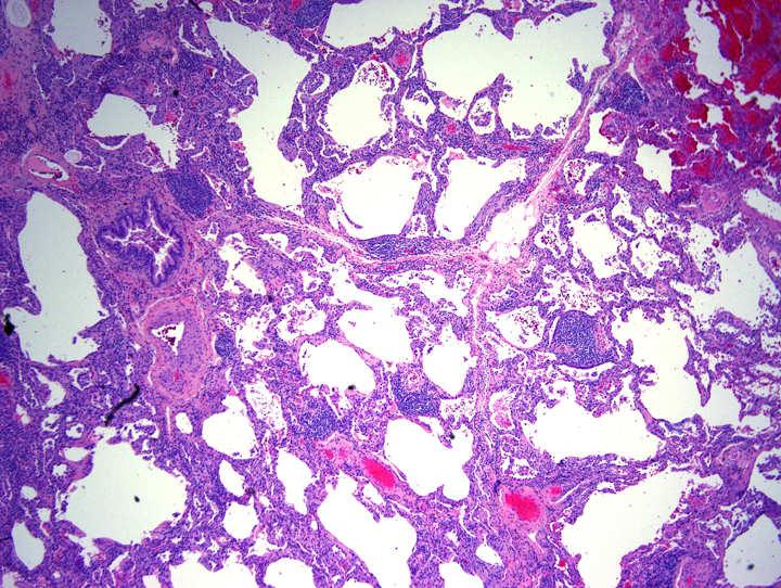 Case 3 - Diagnosis Cellular nonspecific interstitial pneumonia with prominent lymphoid aggregates and