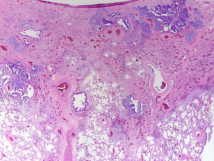 Case 4 MDD Illustrated 62-year-old