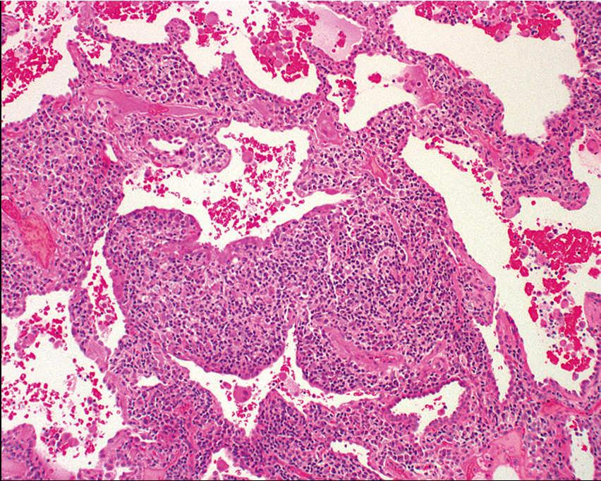 mmm not so much Pattern that has been demoted Lymphoid interstitial pneumonia Histology shows broad expansion of the