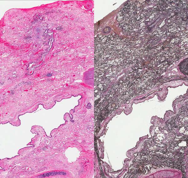 Pleuroparenchymal Fibroelastosis Pleural and subpleural fibrosis Upper lobes show consolidation with traction