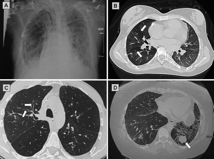 CHAPTER 9 Figure 9.1 Thoracic imaging of lung transplant recipients. (a) Anteroposterior chest radiograph of a recipient with grade 3 primary graft dysfunction (PGD).