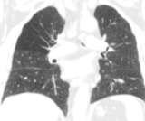 chronic pulmonary emboli)