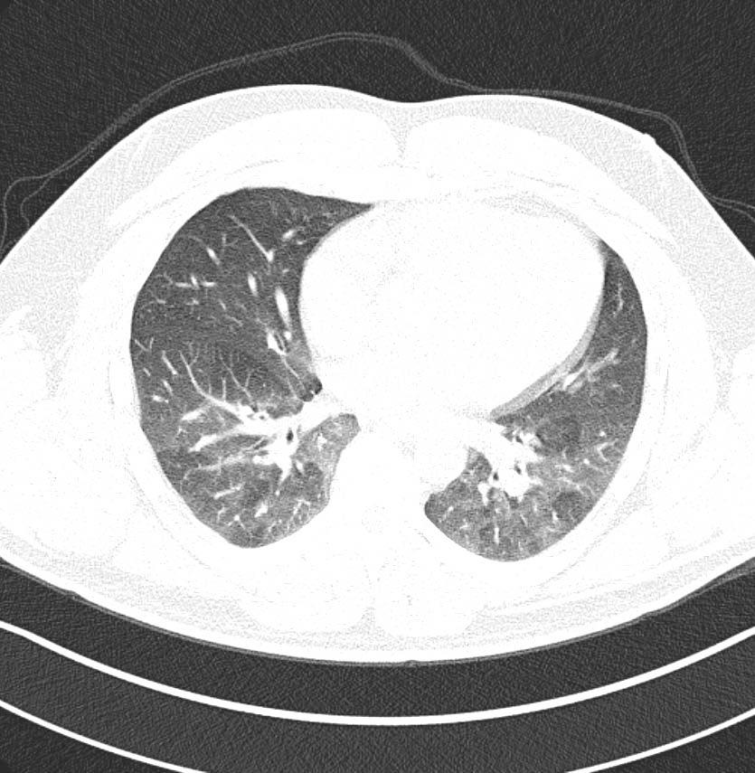 Subtle Chest CT Abnormalities Results Chest CT abnormalities in bronchiolitis: Bronchial wall thickening Centrilobular