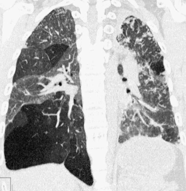 Abbott et al J Thorac Imaging Volume 24, Number 4, November 2009 infection, transplantation, collagen vascular disorders, inhalational lung injury, and ingested toxins.