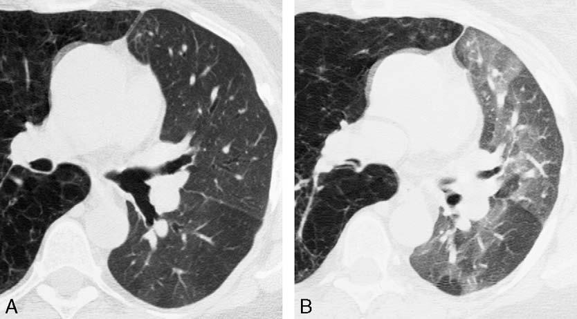 J Thorac Imaging Volume 24, Number 4, November 2009 Imaging of Small Airways Disease FIGURE 18. Constrictive bronchiolitis after lung transplantation.