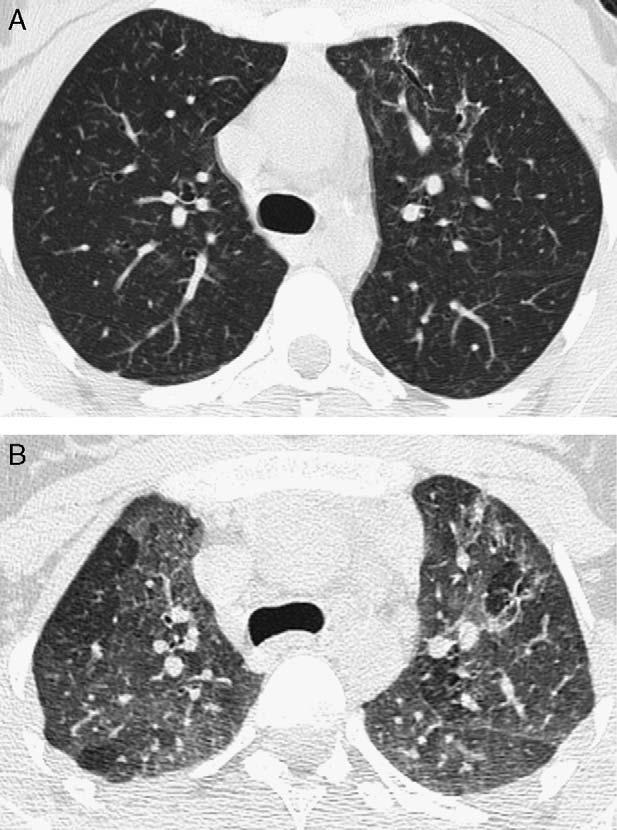 B, Expiratory thin-section chest CT (lung window) of the same patient shows patchy areas of air trapping.
