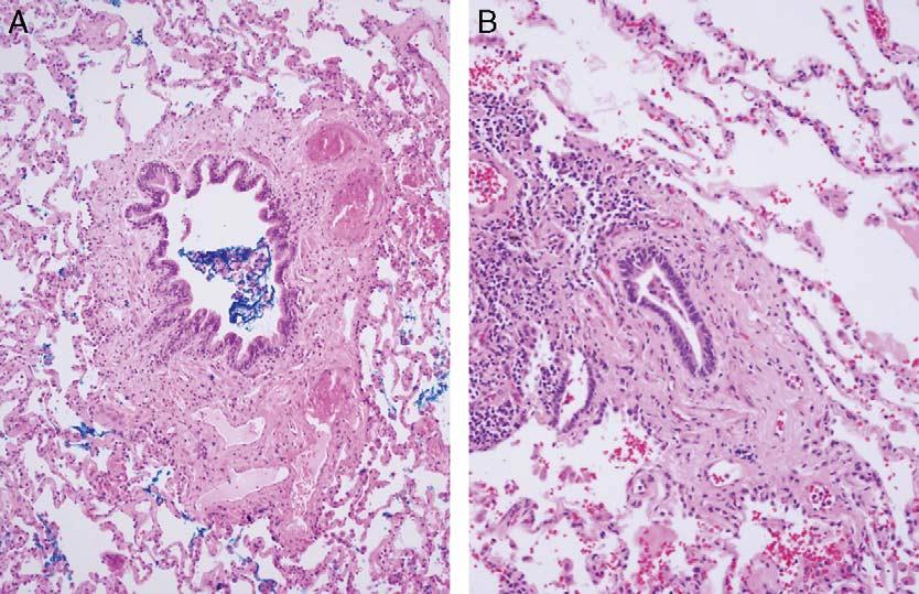 Small airways disease in diffuse idiopathic pulmonary neuroendocrine cell hyperplasia.