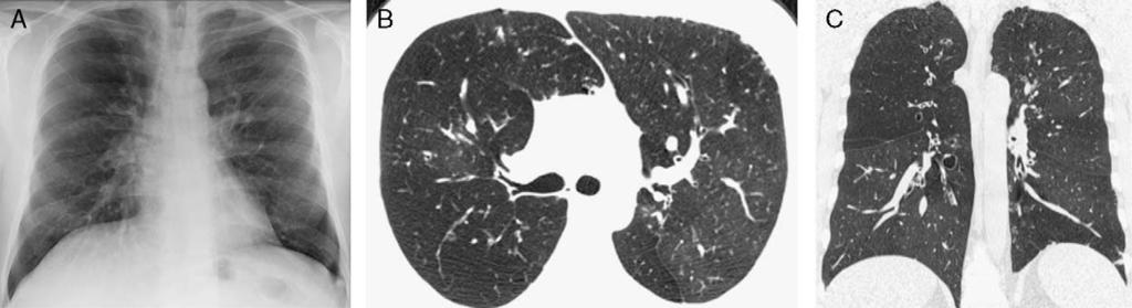 J Thorac Imaging Volume 24, Number 4, November 2009 Imaging of Small Airways Disease FIGURE 22. Constrictive bronchiolitis in Swyer-James syndrome or MacLeod syndrome.