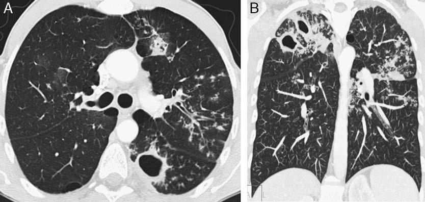 J Thorac Imaging Volume 24, Number 4, November 2009 Imaging of Small Airways Disease FIGURE 9. Bronchiolitis in Mycobacterium tuberculosis infection.