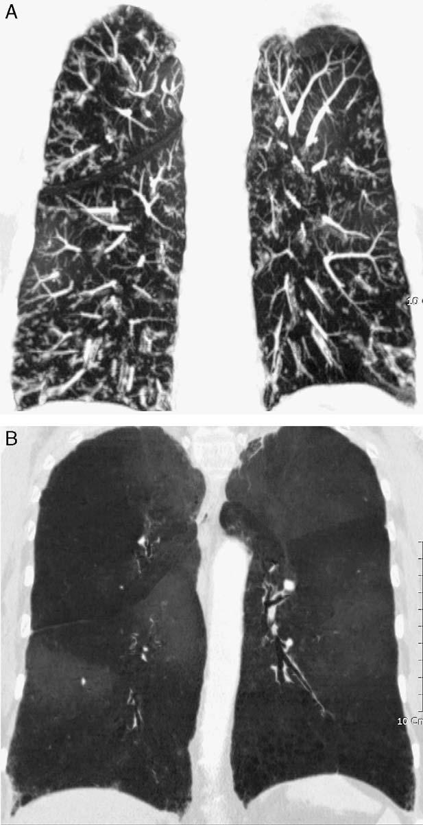 J Thorac Imaging Volume 24, Number 4, November 2009 Imaging of Small Airways Disease Clinical Presentation Patients with DPB typically present with cough and dyspnea on exertion and may have symptoms