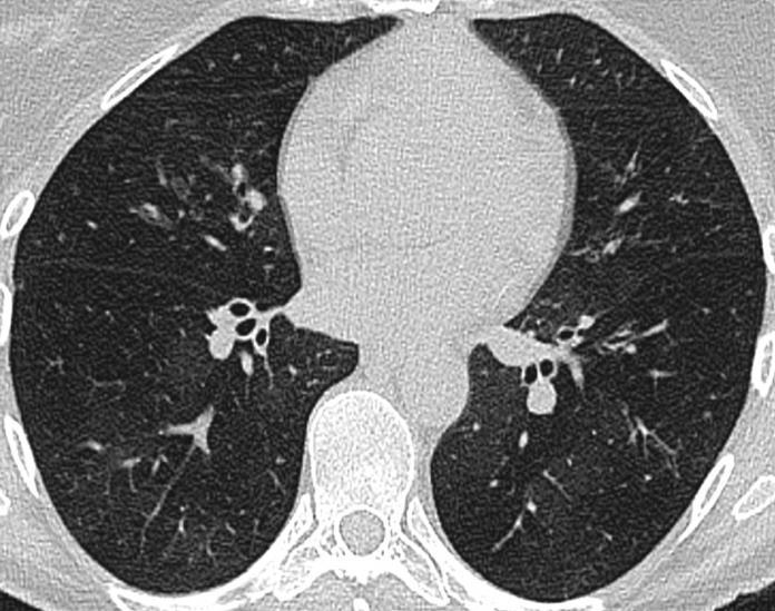 Indirect signs Mosaic attenuation: visualized on inspiratory CT Air trapping: is an indirect sign of obstructive small airways disease that is accentuated on expiratory CT * * * * Expiratory CT is