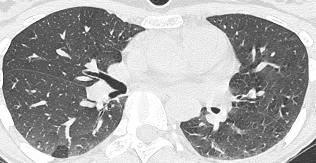 lobular areas of air trapping may be depicted on expiratory CT in dependent portions of the lung.