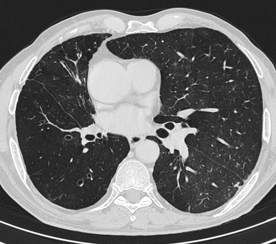 chest x ray On CT we can observe this type of bronchiolitis
