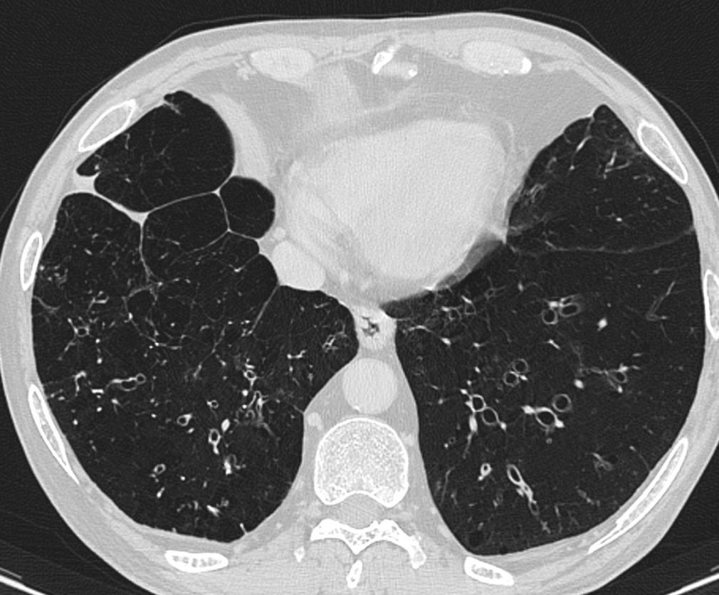 Focal areas of decreased lung opacity with sharp margins Decreased