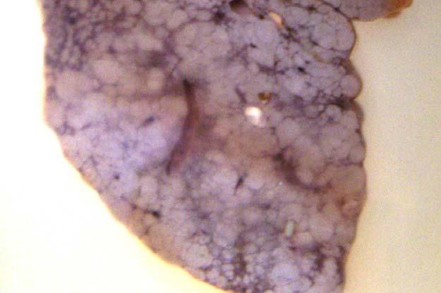 Specimen: A small liver with pale nodules of hepatic parenchymal tissue, surrounded by darker