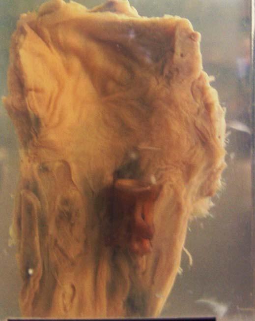 Fish bone in the oesophagus H 930: P Clinical: A male African, 20 years old.