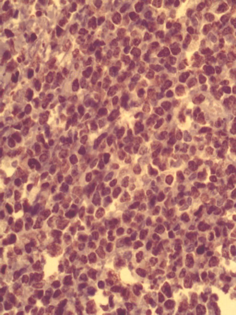 Burkitts lymphoma-immunohistochemistry. Ki67 The Ki-67 is a cellular marker for proliferation. It is strictly associated with ell proliferation.