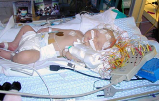 Neonatal Seizures are Common Neonatal seizures are common and often suggest underlying brain injury or dysfunction 50-60% of patients in RCTs Seen commonly during the first 12 hours of life and