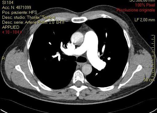 CT Pulmonary Angiography Moderate