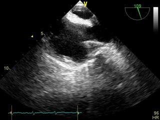 intermittent AF Right heart
