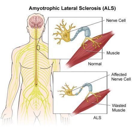 Introduction: ALS Amyotrophic Lateral Sclerosis (ALS): Neurodegenerative disease, compromising upper and lower motorneurons