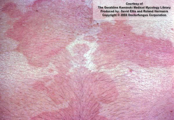 tropic areas There are other species of Malassezia which may or may not be involved in pityriasis versicolor M. obtusa M.