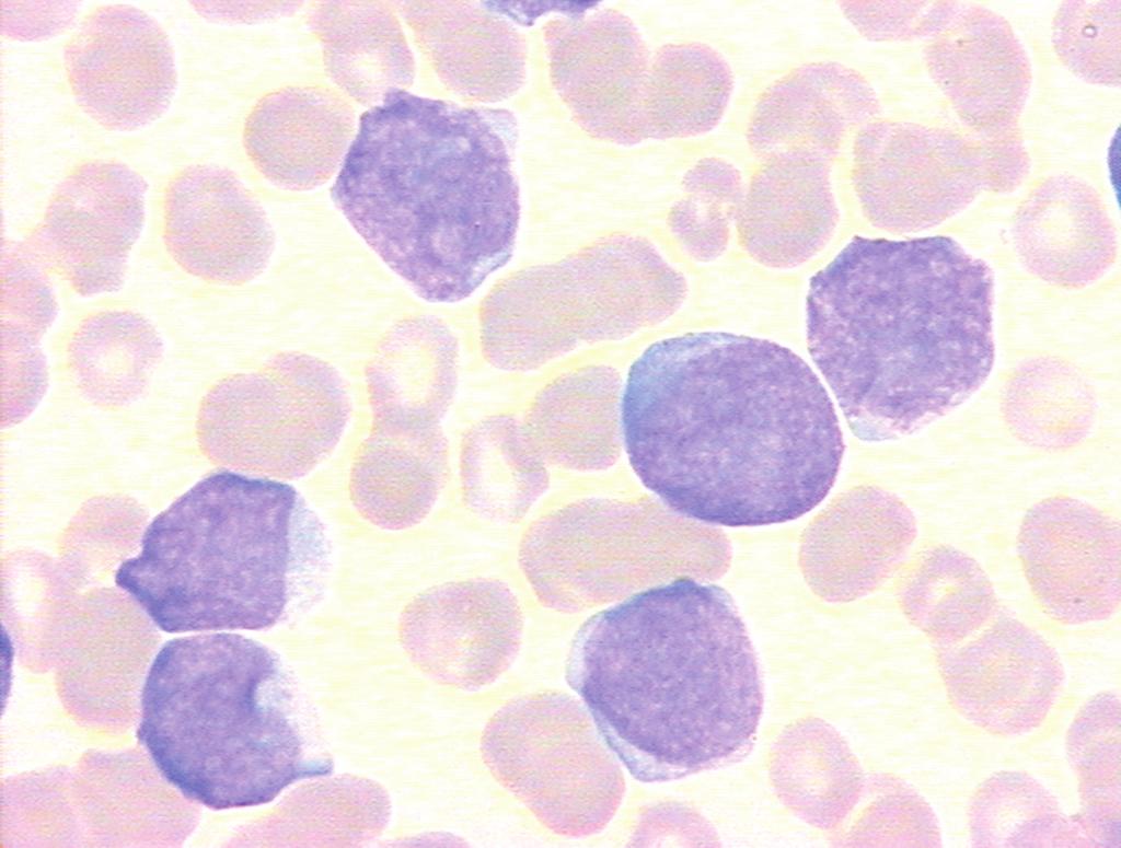 2 Case Reports in Hematology MARKERS Table 1: T-ALL EGIL classification of T lineage acute lymphoblastic leukemia (T-ALL) modified by Szczepanski et al. [2].