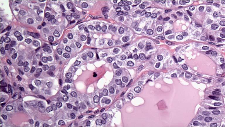 Cytologic Diagnosis CASE Satisfactory for evaluation AUS/FLUS Mixed pattern of fragmented macro- and microfollicles, and mild