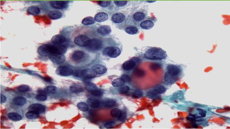 NIFTP has created some challenges for cytology! NIFTP: How Does it Impact Thyroid FNA?
