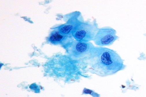 HPV test for Triage of atypical squamous of undetermined significance (ASCUS) ASCUS was found in 3-4% of cervical cytology.