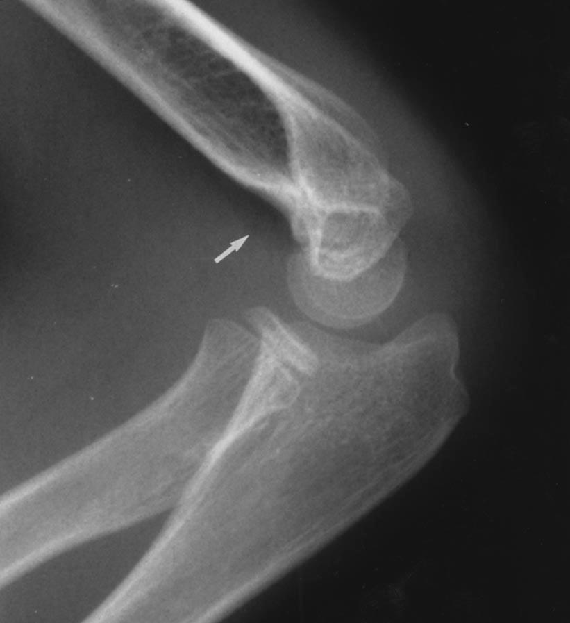 Conventional anteroposterior and lateral radiographs were obtained on a standard imaging system in all children at presentation.