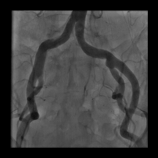 Vascular access Conventional angio +