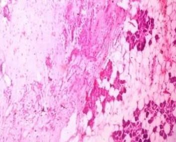 tumours of slivry glnd. sloid intermedite cells nd polygonl epidermoid cells (Figure 3).
