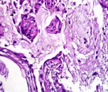 were nlyzed. Figure 2: Wrthin tumour; () ppillry nd glndulr pttern 4x nd () oncocytic chnge nd suepithelil lymphocytes 10x.