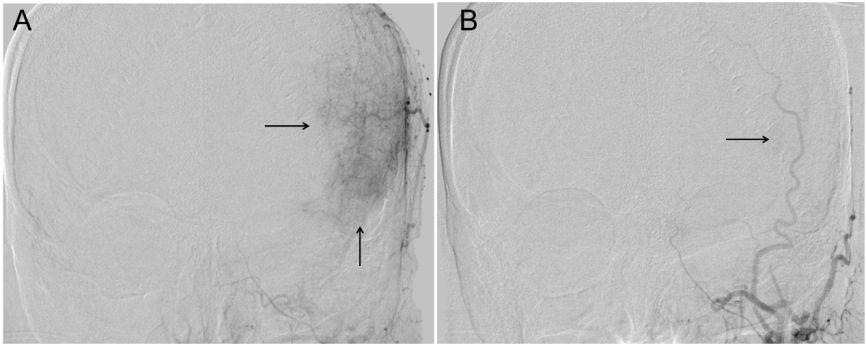 Exairesis evaluation of Kawase approach Evaluation of tumor resection degree: For patients with preoperative embolization treatment, 11 cases of operation degree Simpson 1 was significantly higher