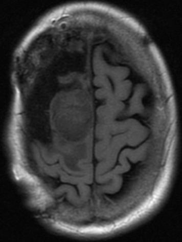 Management of Malignant Meningiomas 11 Fig. 7. Axial MRI of a right parasagittal anaplastic meningioma in a 72-year-old woman.