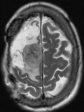2 Computed Tomography (CT) CT scans typically show well-defined, smooth-contoured extra-axial mass, which displaces the normal