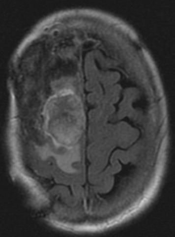 They can be isointense with the normal brain tissue, but they enhance uniformly with the intravenous contrast administration,