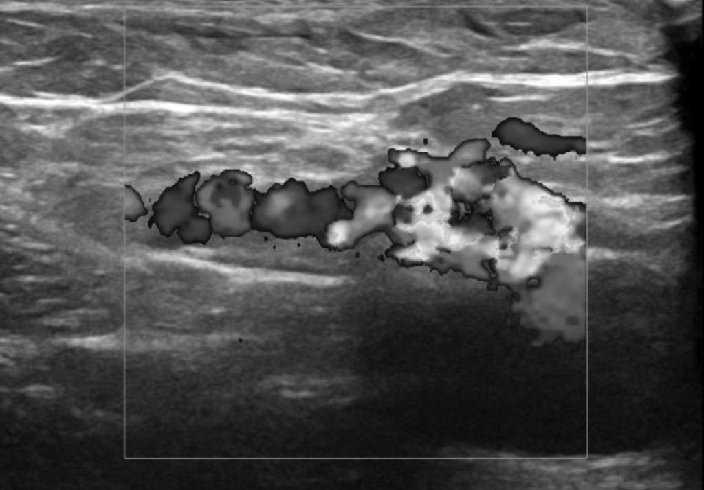 G. Turtulici, et al. Fig. 3: Color Doppler evaluation residual incontinent cross-stump. The recurrences analysis according to REVAS questionnaire are reported in the Tables I, II and III.