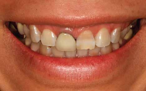 Solution for areas with old crowns: To Replace Old Crowns with White Porcelain Crowns If you have